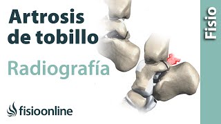 Artrosis de tobillo - Qué es y cómo se diagnostica en radiografías