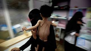 منع التحالف للمساعدات والوقود يهدد المدنيين في اليمن
