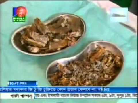 Bangladeshi Tree Man Operation Successful News Bangladesh