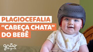 CABEÇA CHATA DO BEBÊ- O QUE É E COMO TRATAR? PLAGIOCEFALIA