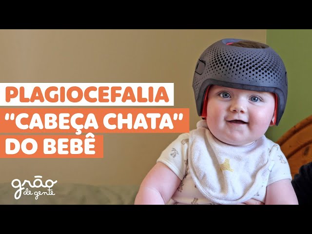 CABEÇA CHATA DO BEBÊ- O QUE É E COMO TRATAR? PLAGIOCEFALIA