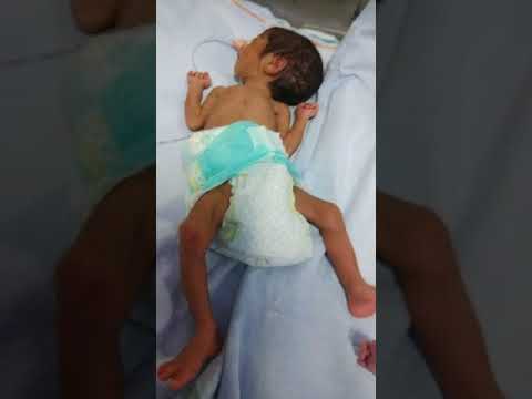 Abnormal Movement In Hand And Foot, Are They Sleep Myoclonus?