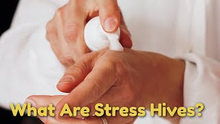 What are stress hives and how best to treat them