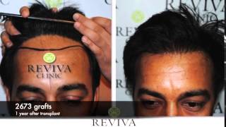 FUE HAIR TRANSPLANT PROCEDURE