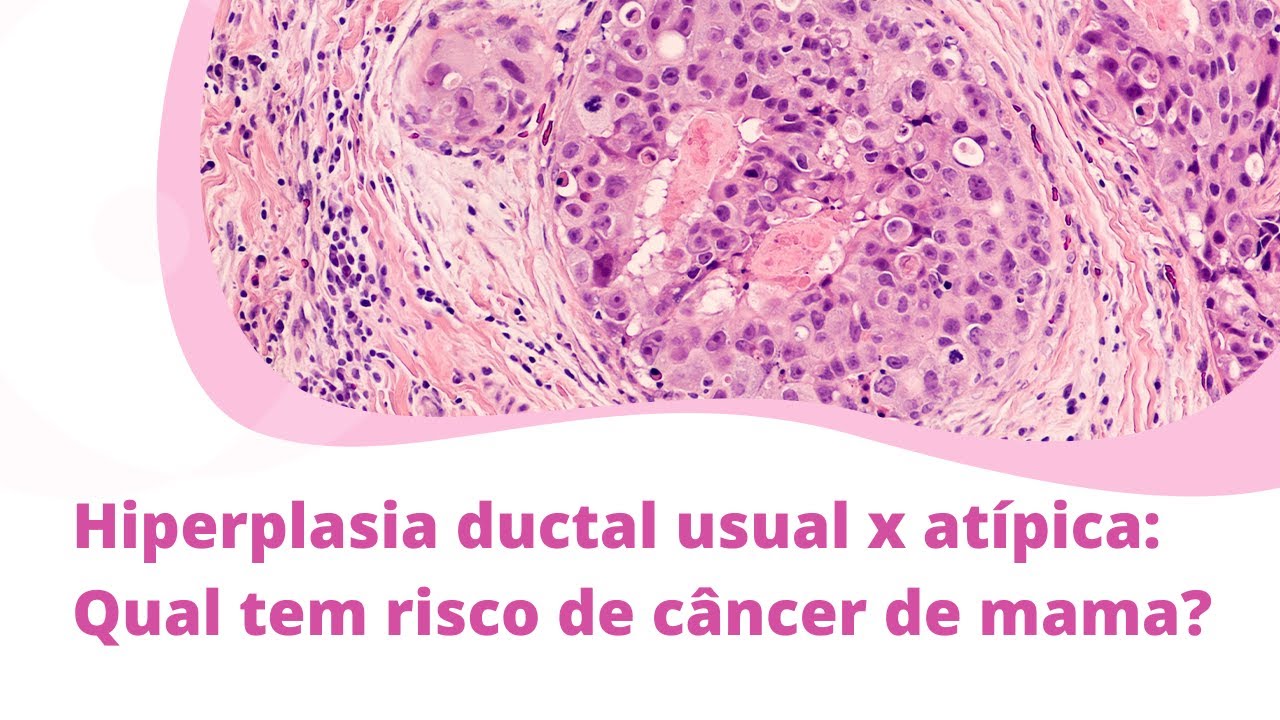 Hiperplasia ductal usual x atípica: Qual tem risco de câncer de mama?