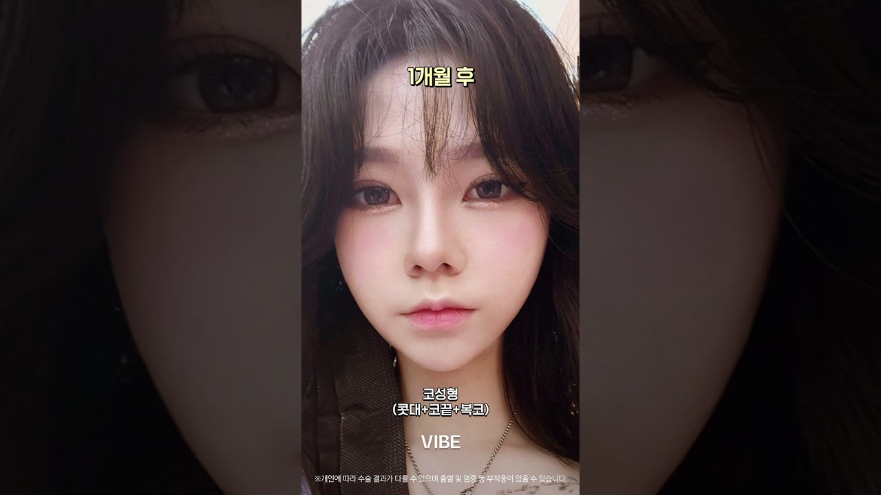 코성형 + 콧대 + 코끝 +복코 #shorts