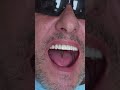 Dental implant’s All on 4 v Praze #shorts #dentist #dental #implant #veneers #short