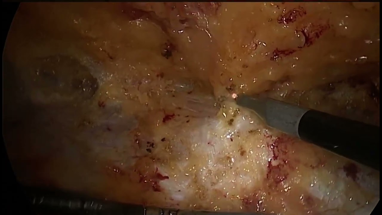 diástase do reto abdominal - correção laparoscópica