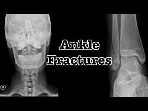 XR I Ankle Fractures