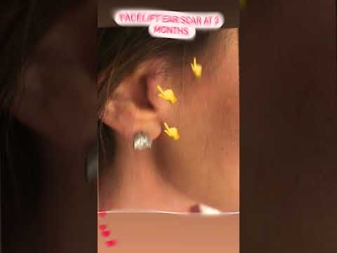 Watch Video: Dr. Rizk shares his patient’s results one week after Rhinoplasty