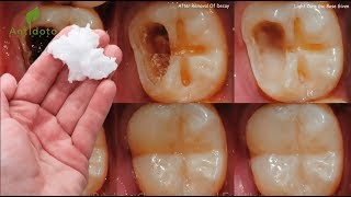 Este es el Remedio que ningún Dentista quiere que Descubras