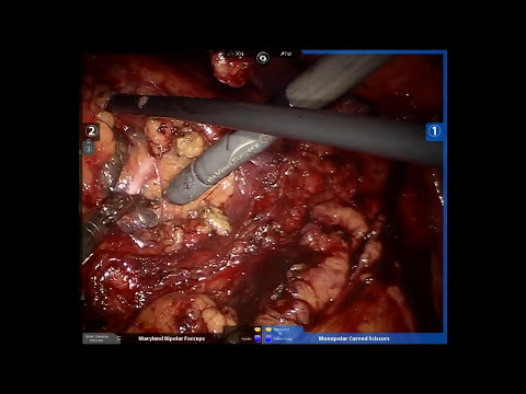 Robotic Assisted Laparoscopic Radical Nephrectomy