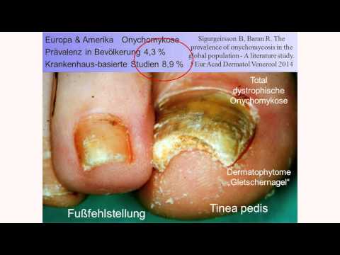 Tetraziklin gegen das Ekzem Nejrodermit, wie zu beruhigen sich