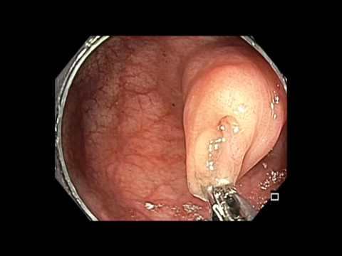 Coloscopie: Polype Caché de l'Appendice - Adénome Dentelé