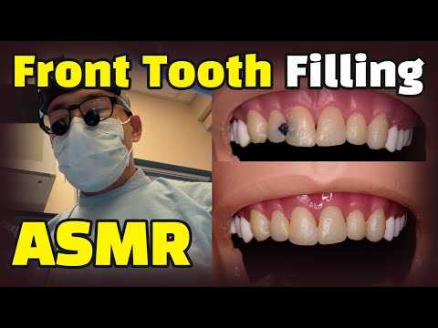 How to fix cavities between front teeth + Dental ASMR (Composite Resin Filling Procedure Explained)