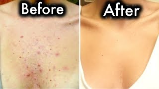 Get Rid Of Chest Acne In Few Days With These Home Remedies