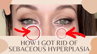 How I GOT RID of Sebaceous Hyperplasia (skin tags/bumps)