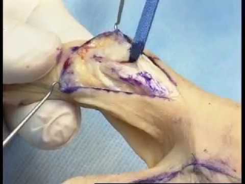 Artroza articulației termice uscate