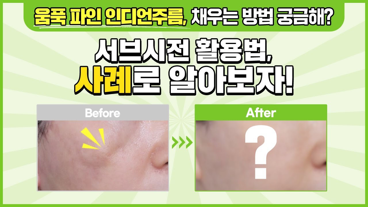 나이 들어 움푹 패인 인디언주름, 수술 말고 간단한 서브시전 방법으로? | 인디언주름, 동안성형 잘하는 곳 …