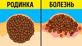 9 Мифов о Родинках и Загаре, в Которые Давно Пора Перестать Верить