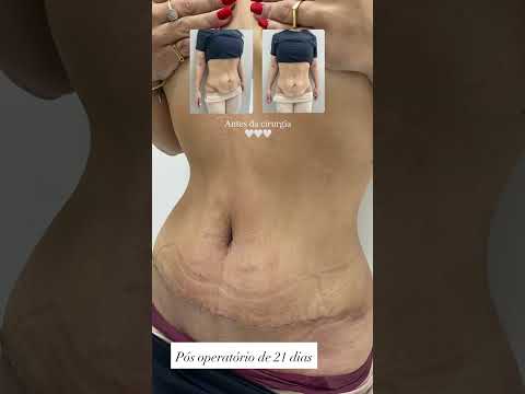 Abdominoplastia em Criciúma e Araranguá - Santa Catarina. Resultados que nos deixam muito felizes!