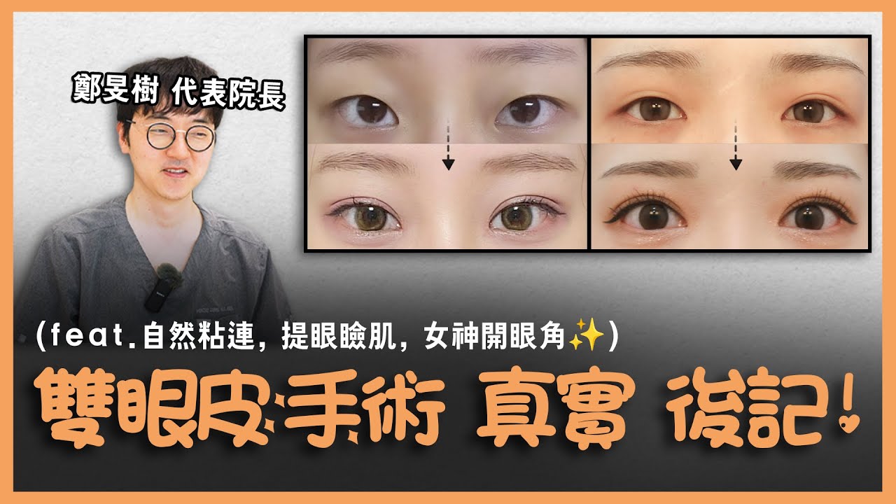 雙眼皮變化實錄：從疲憊無力眼神到神采奕奕明亮雙眸的完美轉變