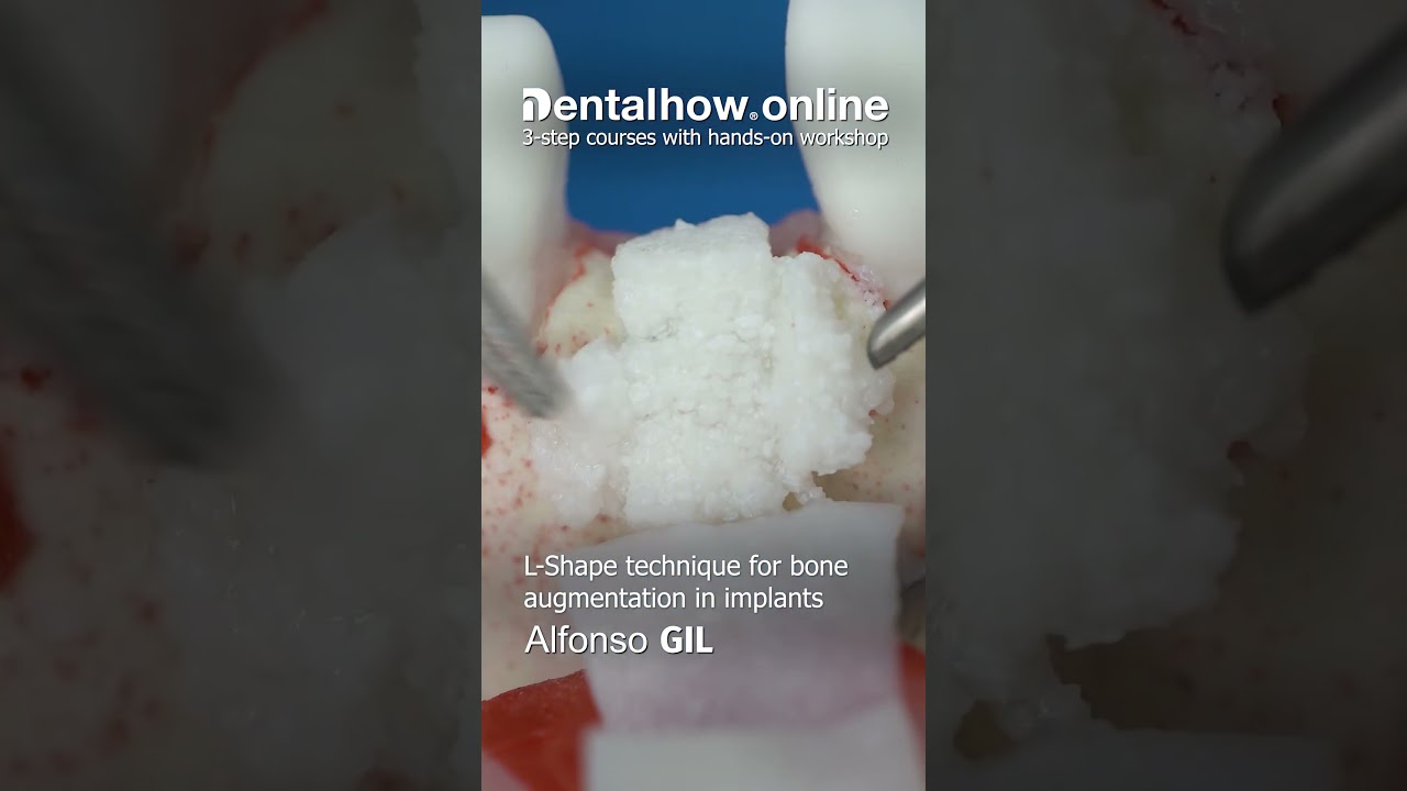 L-Shape Technique | Bone Augmentation