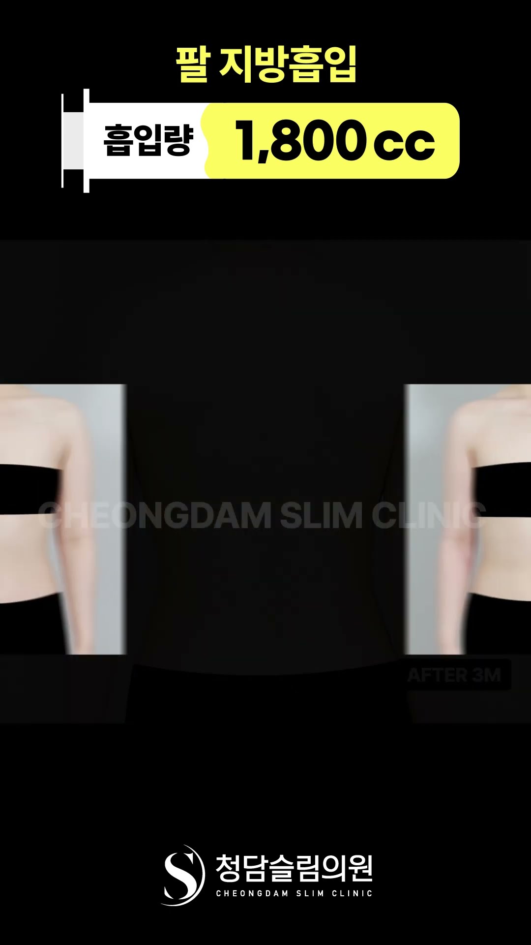 팔 지방흡입 이래서 하는구나?