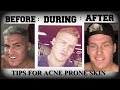 My Acne Skin Care Routine And Tips | *950 dollars a month*