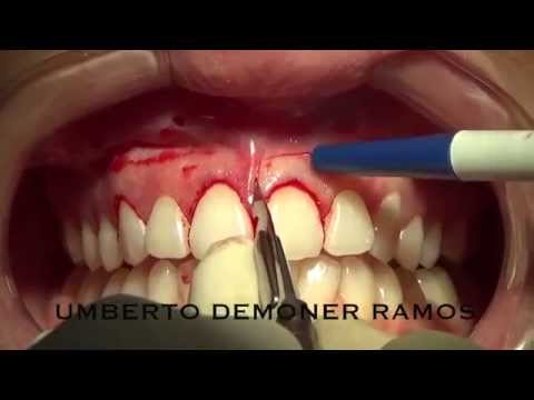 Lip Repositioning for Gummy Smile Correction