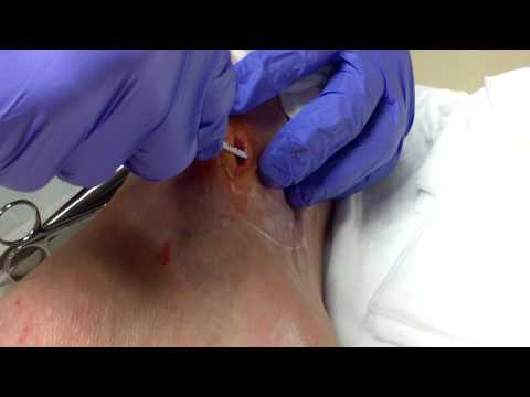 Surgical Debridement of callus and new cell production scraping-Part 1-10/31/2014