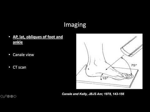 Talus Fractures -  Dr. Shearer
