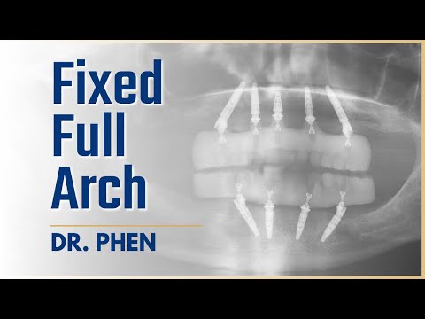 Full-Arch Transformation: Oscar’s All-on-X Case Review