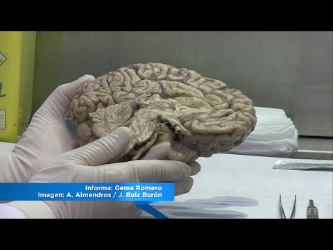 Donación de cerebro para ayudar a la investigación