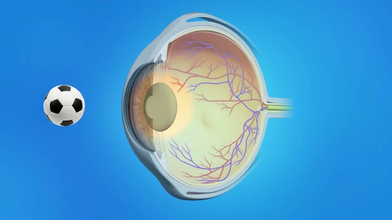 Cataract Cataract Overview