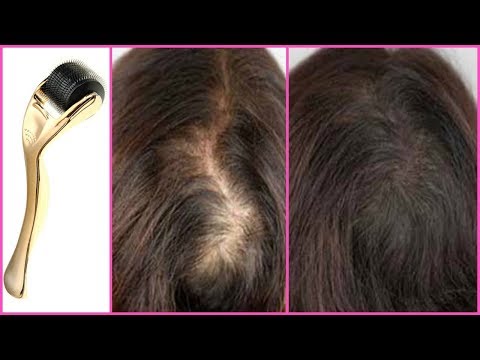 HOW TO REGROW HAIR WITH A DERMA ROLLER│DERMA ROLLING SCALP FOR FASTER HAIR GROWTH │GROW THIN HAIR! Video