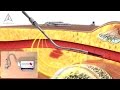 Saranas - Internal Bleeding Detection - 3D Medical Animation