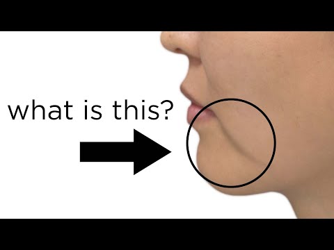 What are Marionette Lines | How to make them go away. Newport Beach Plastic Surgeon explains anatomy
