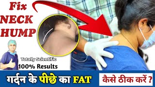 Neck Hump Exercises in Hindi | How to remove fatty Neck Hump | Dowager