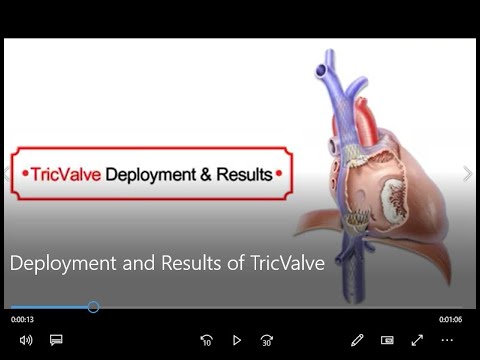Deployment and Results of TricValve