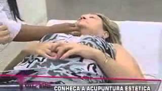 Acupuntura na Estética Facial e Corporal
