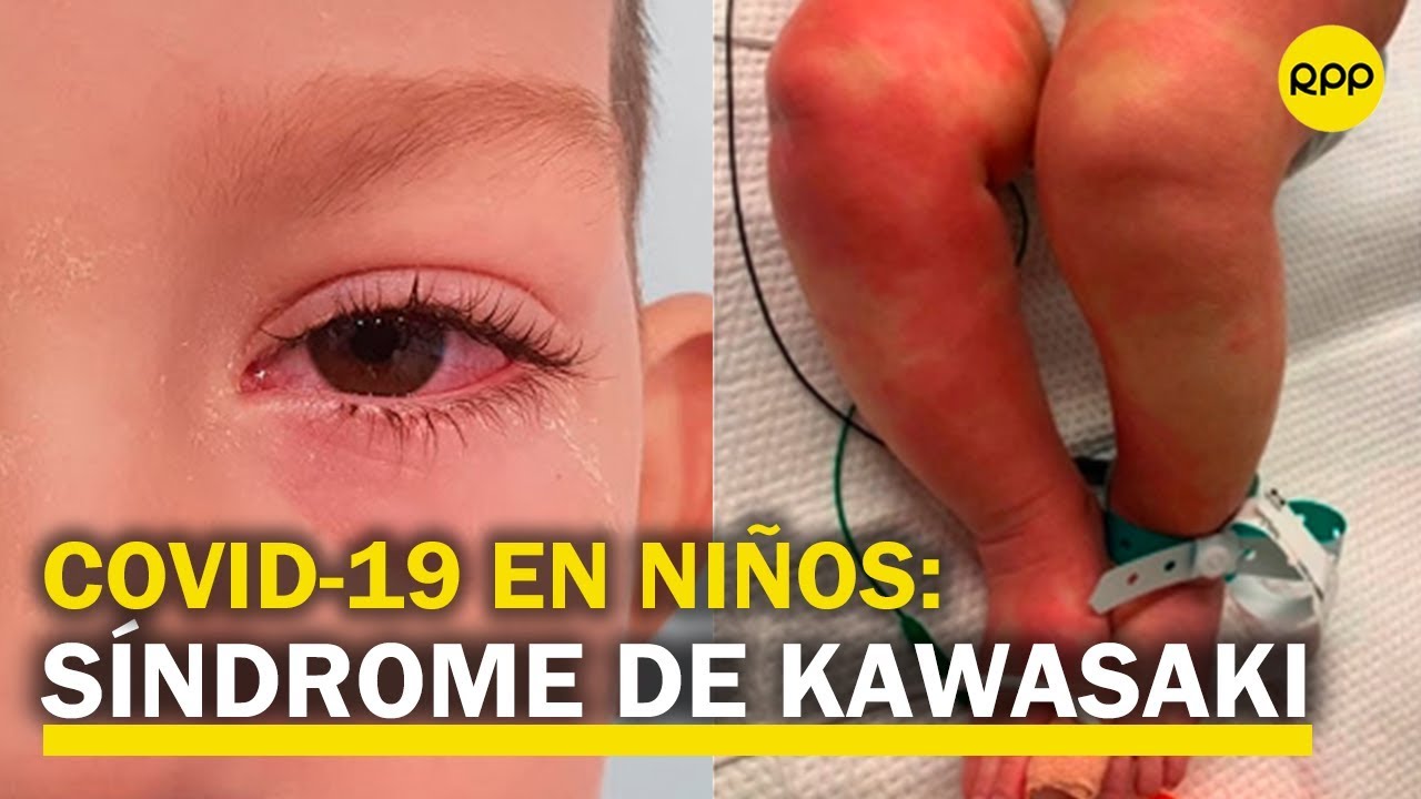 COVID-19 EN NIÑOS: síndrome de Kawasaki y síndrome inflamatorio multisistémico