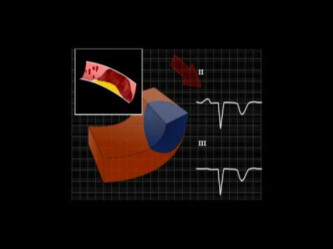 Zawał mięśnia sercowego STEMI w EKG