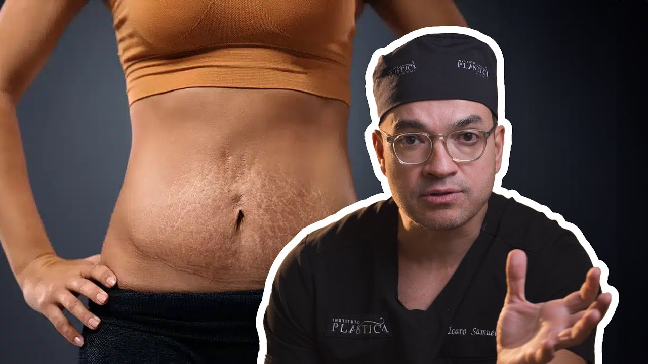 TUDO O QUE VOCÊ PRECISA SABER SOBRE ABDOMINOPLASTIA
