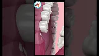 Wisdom Tooth- Swollen Gums (Lower Lateral) Animation