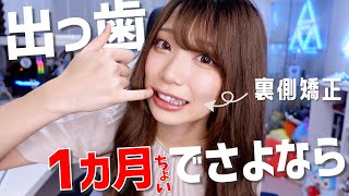 【歯列矯正#2】１・２カ月で感じたデメリットとメリットを辛口で全部話します！見えない裏側矯正
