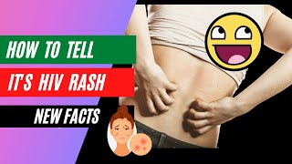 how to tell HIV rash? - clear confusion!