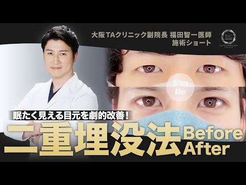 【メンズ美容】垢抜けた目元を手に入れたい! 【二重埋没】