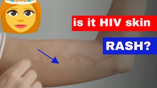 what does HIV rash look like (how to tell HIV rash?)