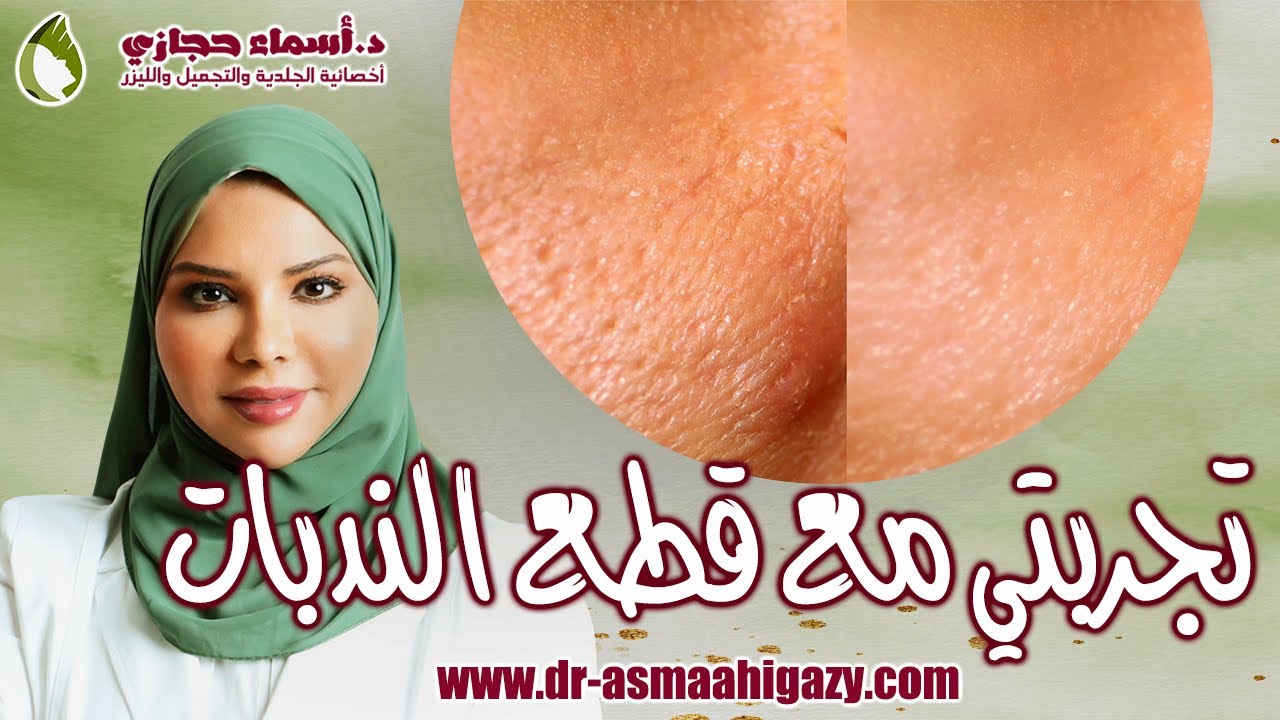 قطع الندبات قبل و بعد | تقطيع الألياف لعلاج ندبات و اثار حب الشباب | دكتور أسماء حجازي